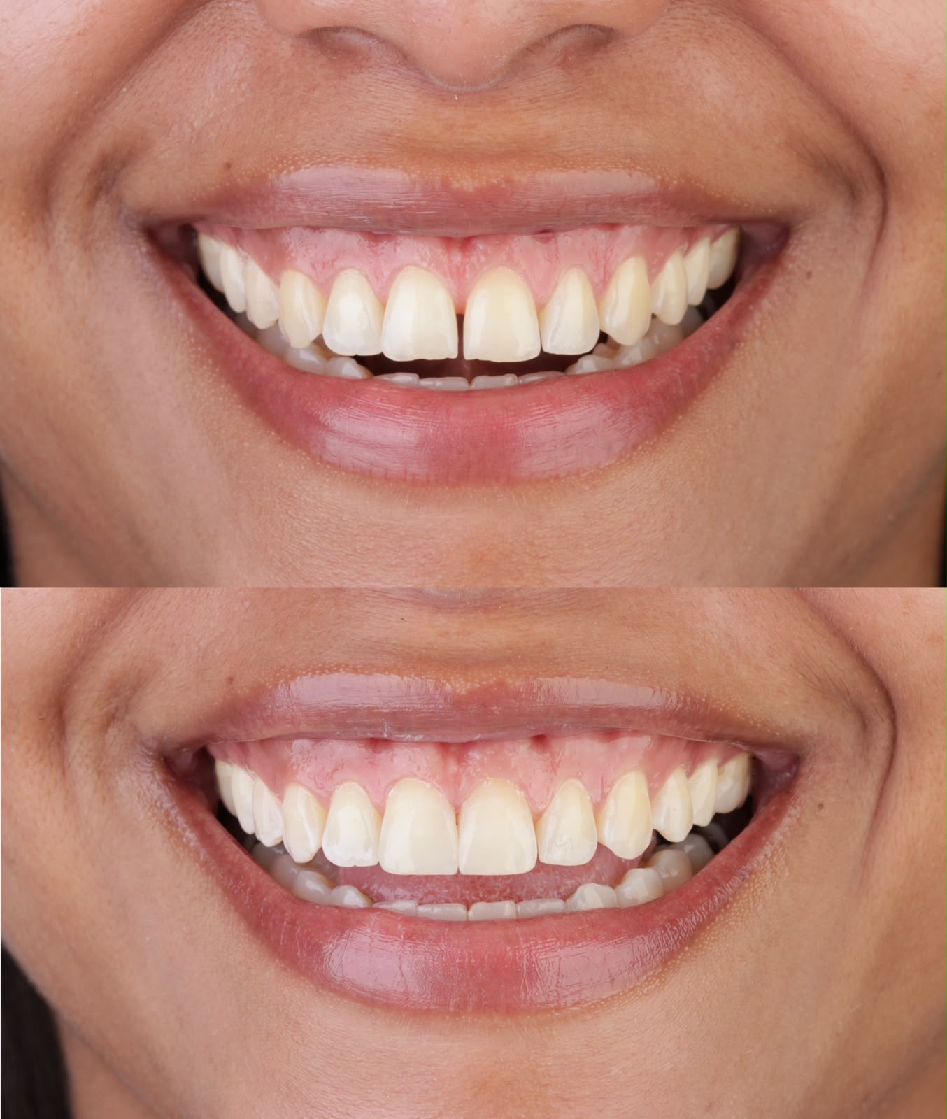 Antes e depois de fechamento de diastema com resina