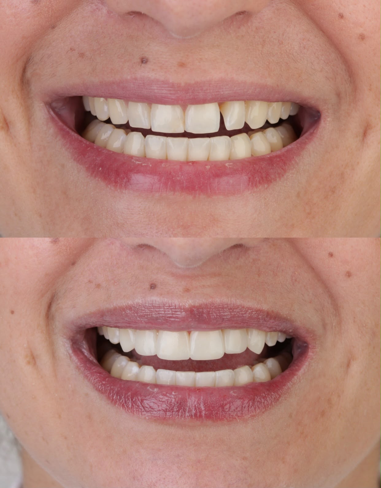 Antes e depois de reanatomização dental com resina