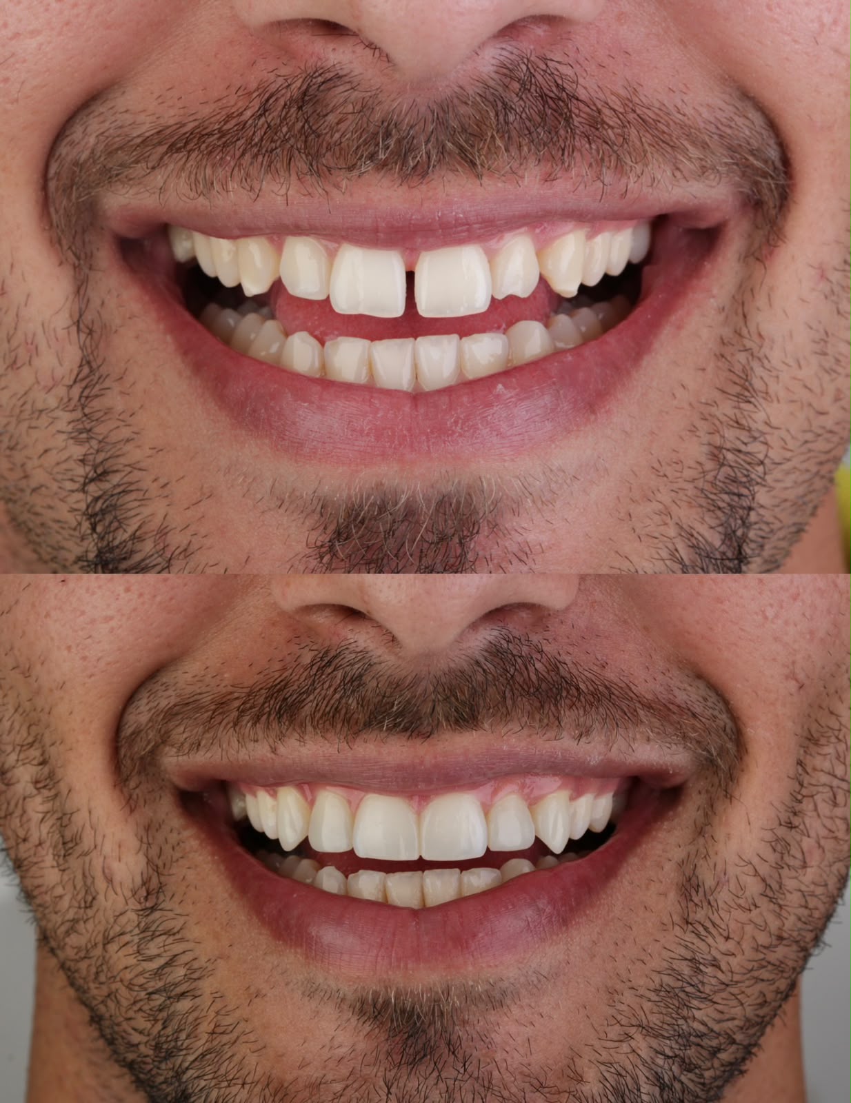 Antes e depois de fechamento de diastema e recontorno com resina