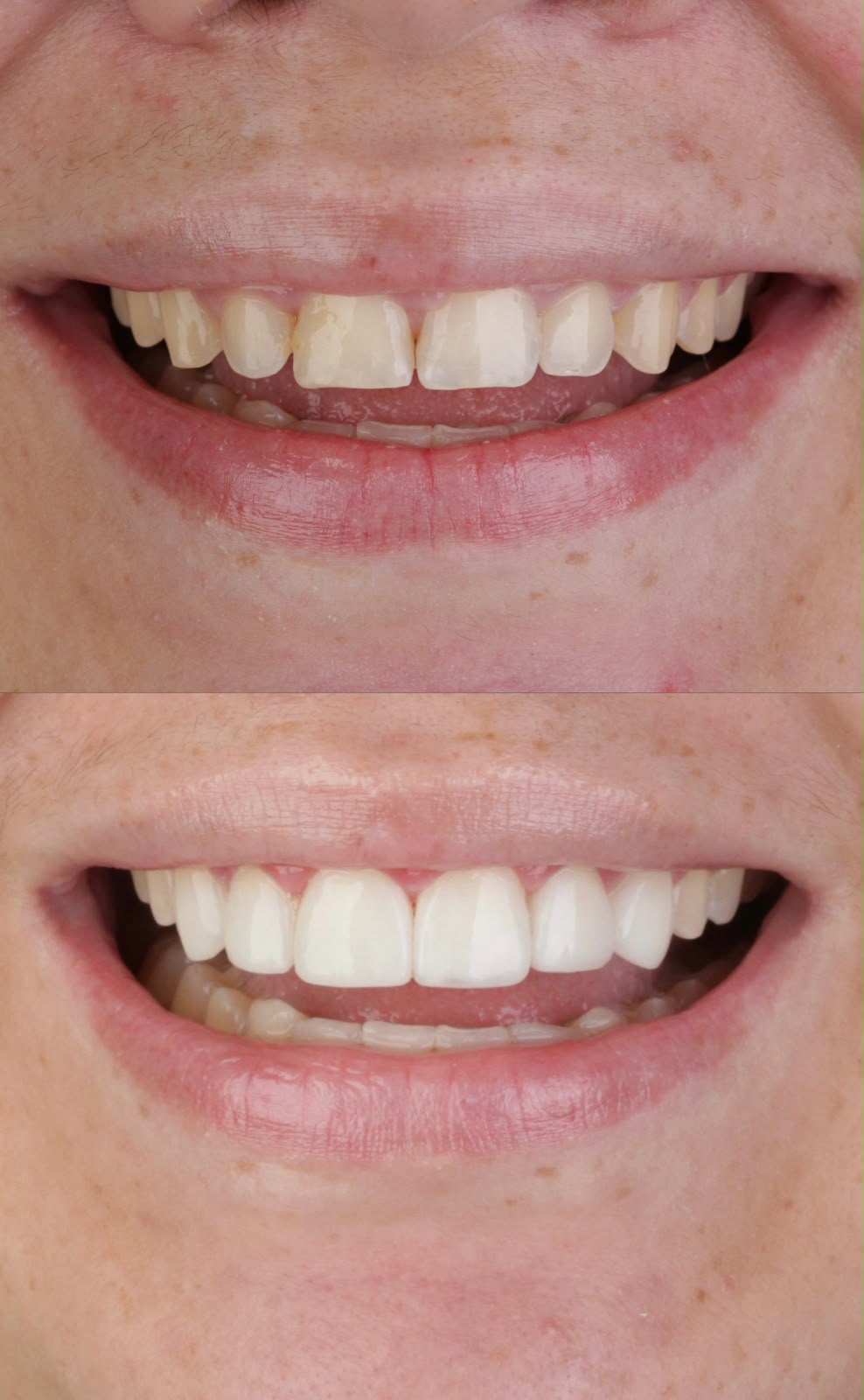 Antes e depois de correção de proporção dental com resina