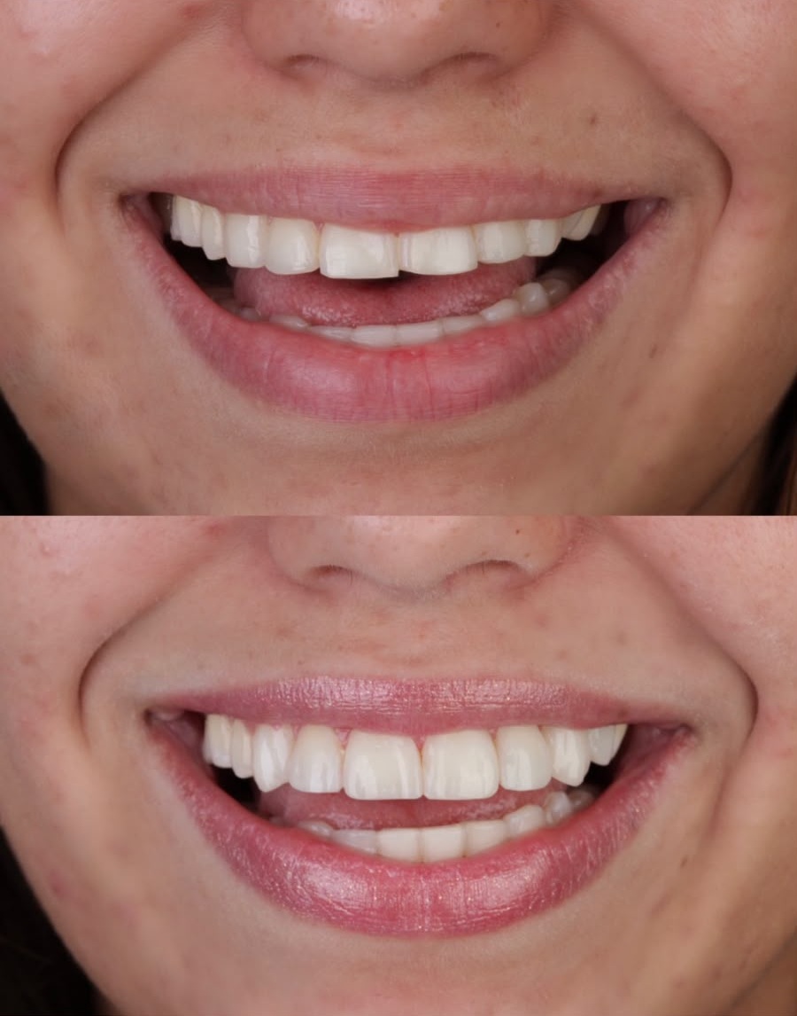 Antes e depois de facetas de resina